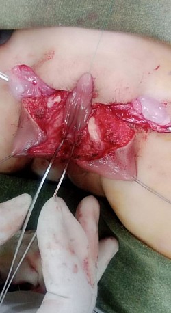 Labial folds dissected open to reform scrotum